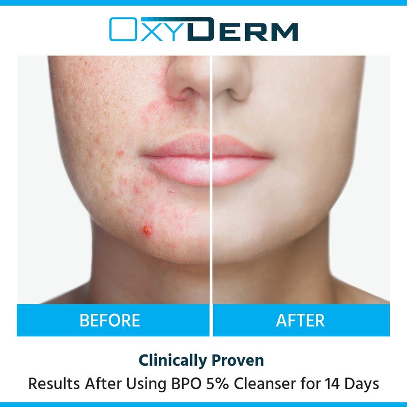 OxyDerm Acne Face wash Treatment with Benzoyl Peroxide 5% - Clinically Proven Wash to Fight Acne Blemishes on Contact. Eliminates Cystic Breakouts, Oily Skin, Clogged Pores, Blackhead, Whitehead, & Pimples. - Image 5